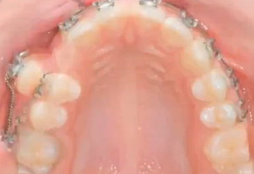 Takılan diş tellerinin ardından iyileşme sürecinin hızlandırılmış videosu